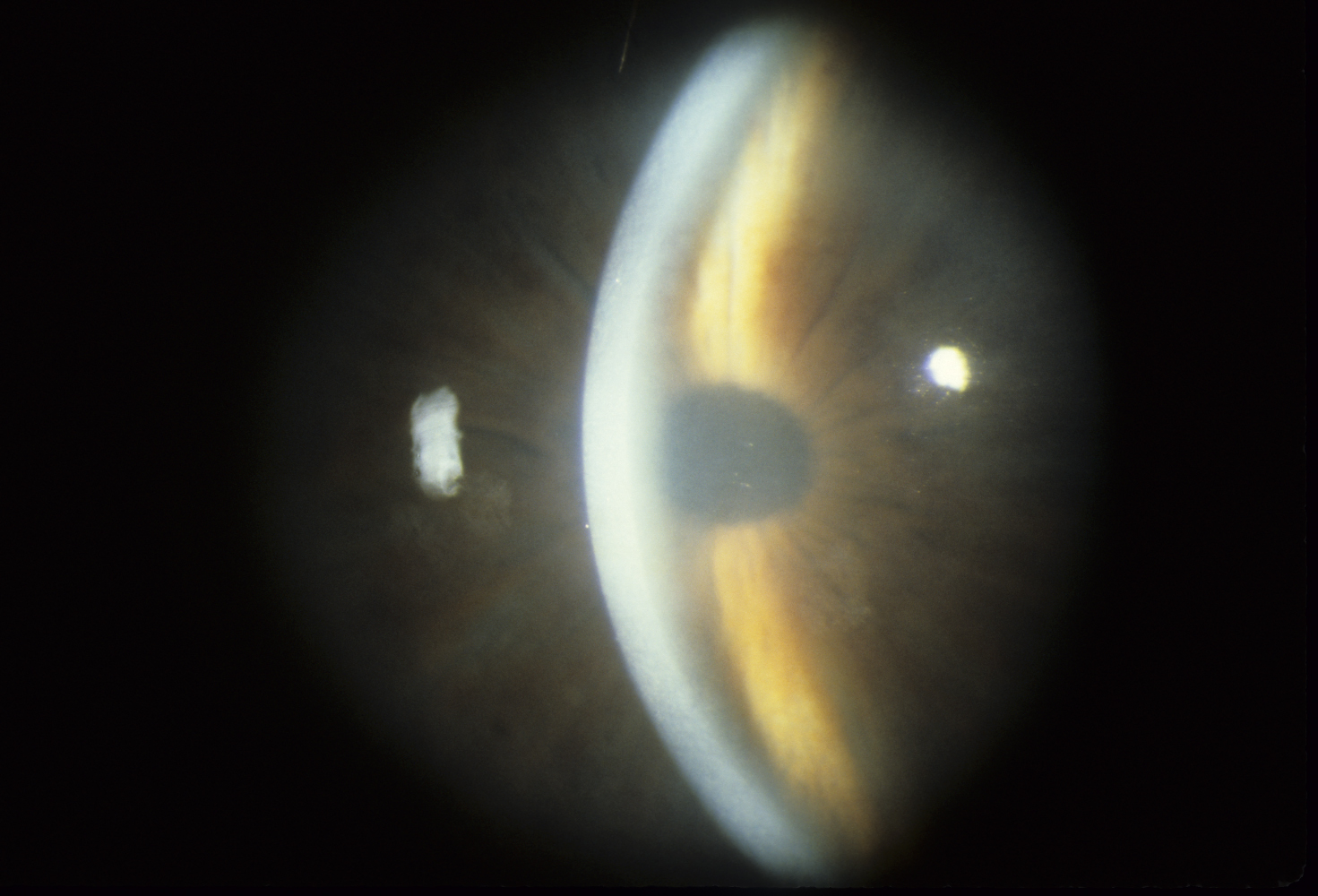 Corneal Dystrophy Fuchs Endothelial Late Onset Hereditary Ocular